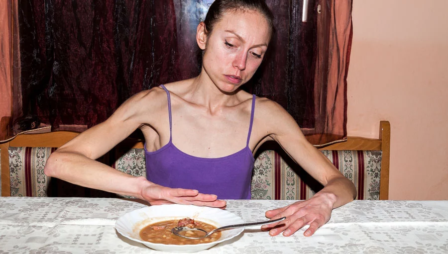 Signs and Symptoms of Anorexia Nervosa