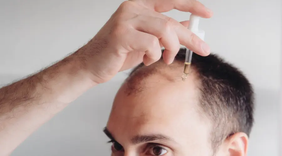 CBD for Hair Loss Treatment